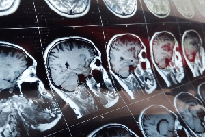 CT scan 