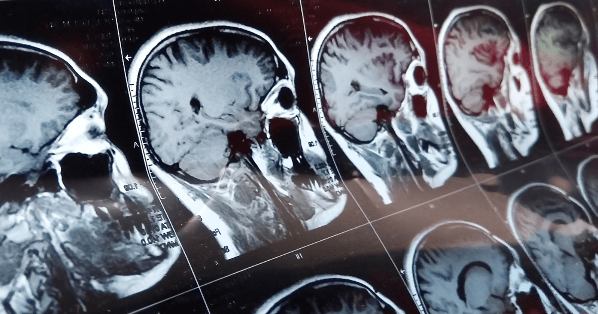 Why Linking a Head Injury to a Car Crash May be Challenging
