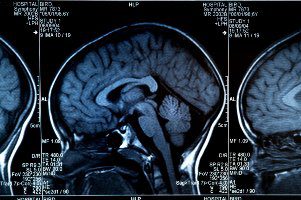 mri of a human brain