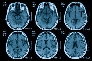 brain mris